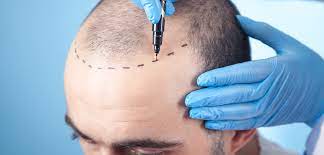 Hair Transplant