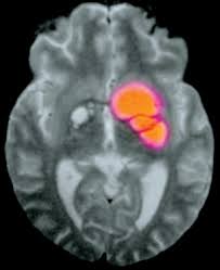 Image result for Cryptococcal Meningitis