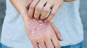 Psoriasis cream лостерин зорька буренка пикладол софора карталин псорилом король кожи скин кап. Kan Bli Nesten Symptomfri Med Nye Medisiner Video Alt Om Din Helse