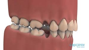 Generally teeth start moving within a few days of braces being placed on to the teeth. Tooth Extraction Consequences Lapointe Dental Centres Youtube
