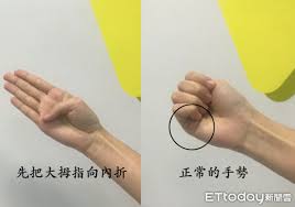 For faster navigation, this iframe is preloading the wikiwand page for 主動脈剝離. é  ææé ­ ç§'æ¸¬ä¸»åèåé¢ å¿èå¤ç§'é«æçç¸ å¥å»äº Ettodayå¥åº·é² Ettodayæ°èé²