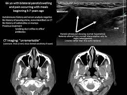 Found 37 sentences matching phrase parotid duct.found in 1 ms. Parotid Duct Stricture Dilation With Salivary Balloon And Ultrasound Guidance Iowa Head And Neck Protocols
