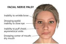 Webmd explains how it's diagnosed and treated. Do Vaccines Cause Bell S Palsy Total Health