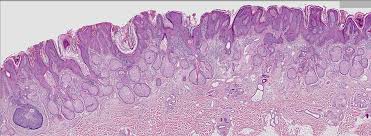 Descriptors are arranged in a hierarchical. Pathology Outlines Nevus Sebaceus Of Jadassohn
