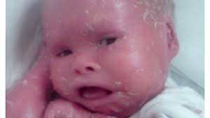 Harlequin ichthyosis, a rare skin disease caused by a mutation of the abca12 gene, requires constant maintenance to harlequin ichthyosis, the rare condition that leaves sufferers mistaken for dolls. Harlequin Ichthyosis Definition Symptoms Treatment And Prognosis