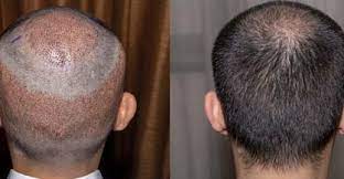 It goes deep inside, strengthens and nourishes the hair root. Hair Care Clinic Hair Loss Treatment Vcare Trichology