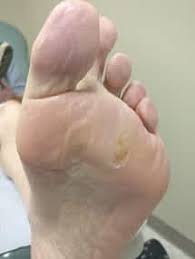 This can be attributed to the antimicrobial properties of the. Athletes Foot Fungus Apple Cider Vinegar Cure The Home Remedy