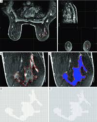 The technology can detect some tumors that mammograms cannot. Visualization And Pixel Processing Sequence Of A Dce Mri Breast Tumor Download Scientific Diagram