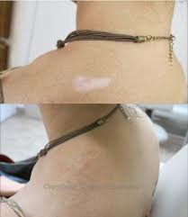 But some people choose to get a tattoo for an entirely different reason, such as to cover up a scar for example. Skin Colored Tattoos To Cover Scars Lovetoknow