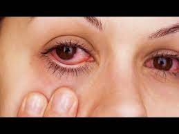 Maybe you would like to learn more about one of these? How To Instantly Relieve Itchy Irritated Allergy Eyes Youtube