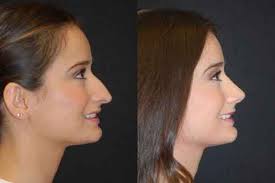 Plastic Surgery Associates 13 Rhinoplasty Before And After Rhinoplasty Nose Job