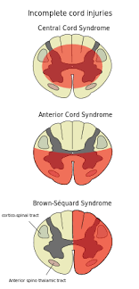 spinal cord injury wikipedia