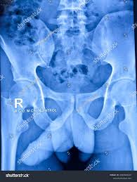 Image result for Retrograde Urethrogram