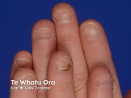 Image result for Onychotillomania feet