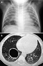 Image result for Lung Abscess
