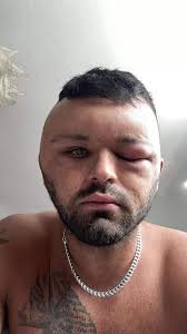 Never mind Monkey Pox