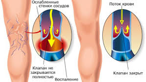 Makanan yang baik untuk penderita asam urat adalah yang rendah purin. Varicosity Varicosity