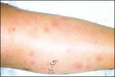 Simptomele pot include simptomele zonei zoster pot arăta ca alte afecțiuni sau probleme medicale. 73 Boli Dermatologice Ideas SÄƒnÄƒtate Diete Detoxifiere Tratamente Pentru Piele