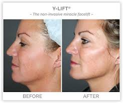 Book a consultation, get contact information for this practice, . Y Lift Facelift Asheville Nc Biltmore Restorative Medicine Aesthetics Thread Lift Face Facelift Dermal Fillers
