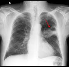 Image result for lung cancer xray