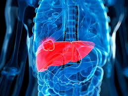 The treatment of choice for a solitary liver tumor is surgery, provided that it has not spread to another internal organ.an abdominal incision is made to expose the liver and associated tumor. How Lung Cancer Spreads To The Liver