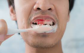 Sakit gigi adalah kondisi ketika muncul rasa nyeri di dalam atau di sekitar gigi dan rahang. Gusi Berdarah Obat Gejala Penyebab Dan Lainnya Hello Sehat