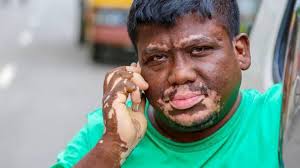 Skin Diseases: Vitiligo And Leukoderma | treatment | Homeopathic | Best Homeopathic Doctor in Pakistan | Dr Qaisar Ahmed MD, DHMS