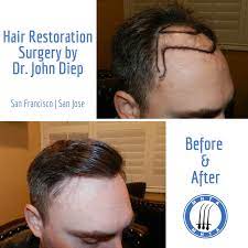 Hair loss fat loss children's books product reviews. Bay Area Hair Transplant Testimonials Hair Transplant Hair Restoration Surgery Hair Transplant Hair Transplant Women