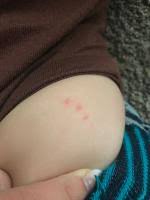 Die stiche/bisse jucken nicht, sind unterschiedlich groß, ich habe sie mehrmals am oberschenkel, an der wade, mehrmals am bauch und am arm. Stiche Oder Bisse An Babys Bein Forum Baby Urbia De