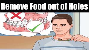 With the plunger pressed all the way down into the syringe, place the tip of the syringe in a clean cup containing saline or tapwater. How To Remove Food Out Of Holes From Extracted Wisdom Teeth Youtube