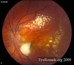Pin By Kacie Howard On Coats Disease Arm Yourself With Knowledge Eye Health Vision Eye Retina Surgery