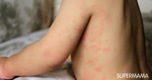 ما أسباب الطفح الجلدي عند الأطفال سوبر ماما