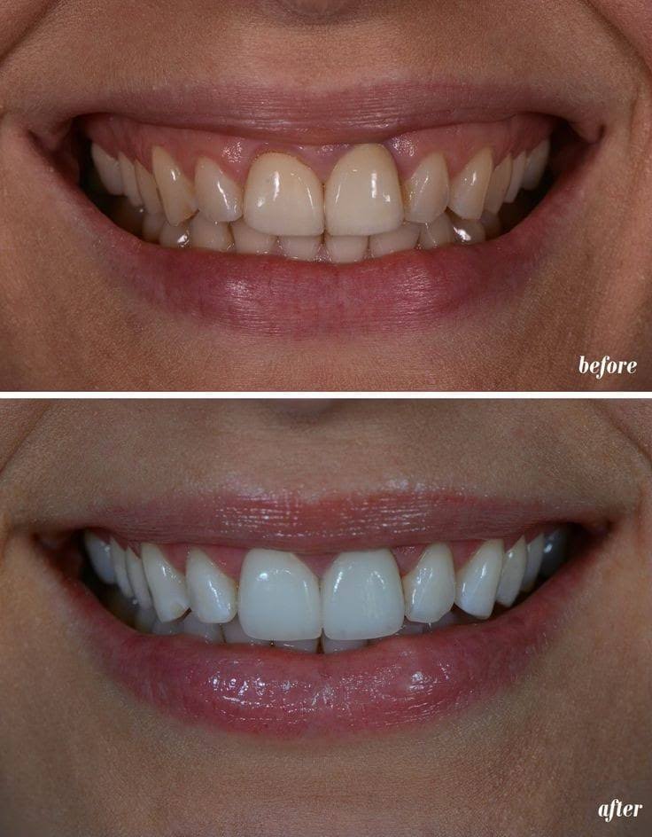 Gum Lift product image