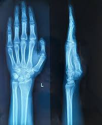Image result for Hand XRay
