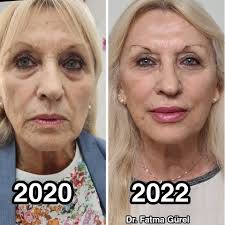 Bei dieser wunderschönen Lady, haben wir in den letzten 2 Jahren,  regelmäßig Botox gespritzt, 1 malig die Augenringe unterspritzt,  nasolabial-Falten unterspritzt, Lippenunterspritzung, Wangenaufbau und  Kinnaufbau durchgeführt. Was sagt ihr zu dem Ergebnis?