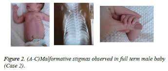Poland syndrome is a congenital malformation affecting the chest muscle and hand on one side of the body. Poland Syndrome Two Cases Of New Borns With Left Sided Chest Defect And Dextrocardia