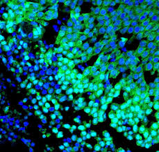 Dense breast tissue makes mammograms hard to. Detonating Fuse For Breast Cancer Discovered