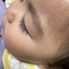 耳鼻科後に点状出血？！ | あらぽん嫁 よめぽんオフィシャルブログ Powered by Ameba