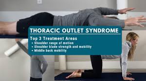 Thoracic Outlet Syndrome Heafner Health