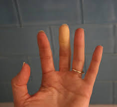 Raynaud S Syndrome The Condition That S As Common As Hay Fever That Most People Don T Know They Have Healthista