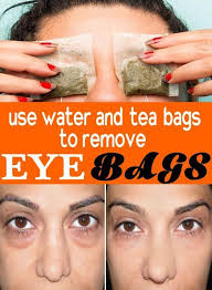 How To Get Rid Of Bags Under Eyes Fast Best Home Remedies Remove Eyebags Remove Eye Bags Under Eye Bags Undereye