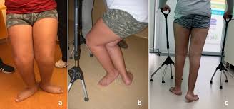 Image result for Gait