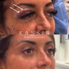Brow Lift NYC vs Upper Blepharoplasty NYC: Understanding the Difference —  Kassir Plastic Surgery in NY and NJ