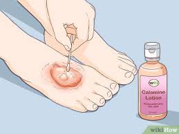Tips for treating poison ivy. 4 Ways To Get Rid Of Poison Ivy Rashes Wikihow
