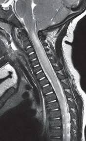 Transverse myelitis interrupts the messages that the spinal cord nerves send throughout the body. Acute Transverse Myelitis Radiology Key