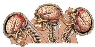 Image result for traumatic brain injuries