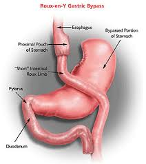 When testing a real client that is using e.g. Help Obesity Now Laparoscopic Gastric Bypass