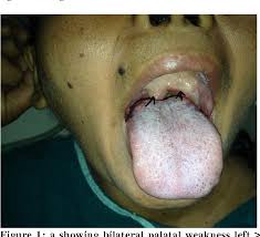 Image result for Progressive Bulbar Paralysis