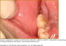 Image result for Labial mucosa