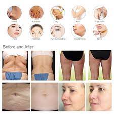 Is lymphatic drainage different on the face than on the body? Lymphatic Drainage Massage Vacuum Rf With Roller Vacuum Roller Machine For Body China Velashape Slimming Machine Velashape Made In China Com